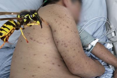 Người đàn ông 62 tuổi suýt chết vì bị ong đốt 300 nốt