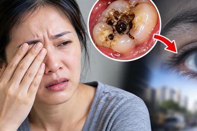 Người phụ nữ 35 tuổi suýt mất thị lực vì ổ sâu răng lâu năm
