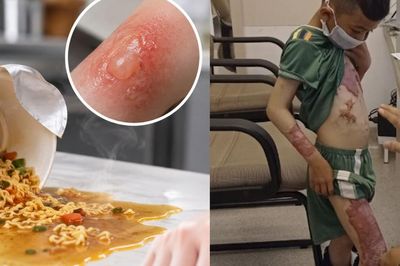 Bé 3 tuổi bị nước mì nóng đổ vào người, mẹ cứu con nhờ làm việc này