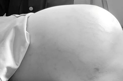 Phẫu thuật thành công khối bướu buồng trứng nặng 15 kg ở bé gái 14 tuổi