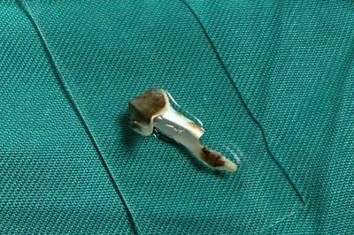 Bé 13 tuổi bị dị vật nhựa mắc kẹt trong phế quản suốt hơn 3 năm