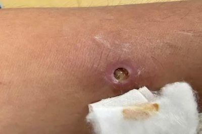Nhiều bệnh ký sinh trùng vẫn lưu hành tại Việt Nam