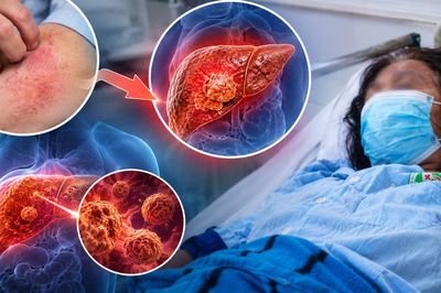Tưởng dị ứng hải sản, người phụ nữ 45 tuổi bàng hoàng được phát hiện mắc ung thư gan nặng