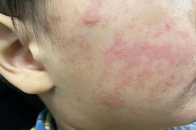 Số ca mắc sởi ở Mỹ vượt hơn 4.500 ca, 479 bệnh nhân phải nhập viện