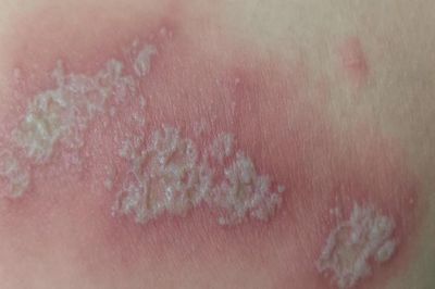 Viêm da tiếp xúc do kiến ba khoang, cách xử trí đúng tránh lan rộng