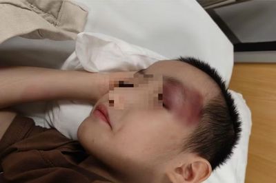 Thông tin mới vụ bé trai 6 tuổi bị chấn thương sọ não khi gửi tại cơ sở can thiệp