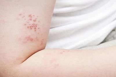 Bác sĩ tại nhà Nhận biết và điều trị tổn thương do zona thần kinh