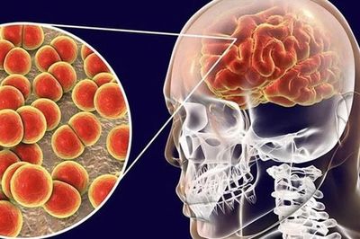 Bệnh do não mô cầu có thể diễn tiến tối cấp: 5 dấu hiệu cha mẹ không nên bỏ qua
