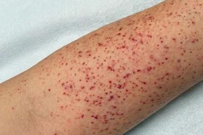 Dấu hiệu cảnh báo bệnh não mô cầu đang chuyển nặng