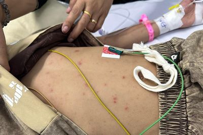 Bác sĩ Trương Hữu Khanh nói về bệnh não mô cầu