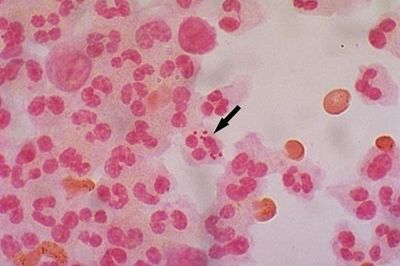 Bệnh có thể diễn tiến nhanh, nhóm tuổi 11-15 chiếm tỷ lệ cao