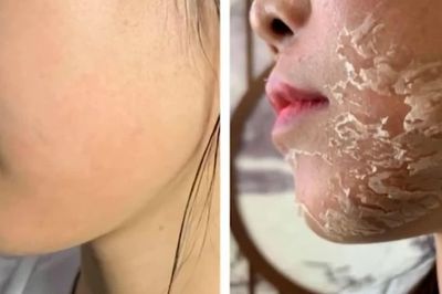 Làm đẹp cấp tốc, trả giá bằng tổn thương làn da