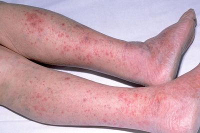 Những biểu hiện điển hình của bệnh não mô cầu