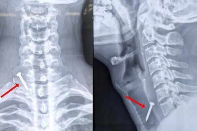 Nam công nhân ở Đắk Lắk bị đinh bắn trúng cổ, thủng tĩnh mạch cảnh