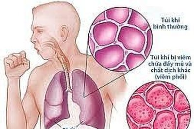 Viêm phổi - nguyên nhân tử vong hàng đầu trong các bệnh về đường hô hấp