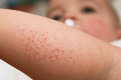 Cẩn trọng khi trẻ bị rôm sảy