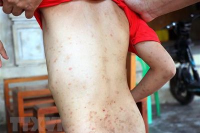 Hà Tĩnh: Ngăn chặn tình trạng người dân bị bọ chét cắn, gây mẩn ngứa