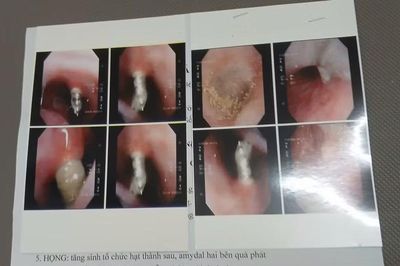 Niềng răng, vít chọc thẳng vào xoang mũi bệnh nhân, bệnh viện nói gì?