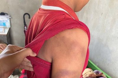 Công an xác minh vụ cháu bé đầy vết bầm tím trên cơ thể