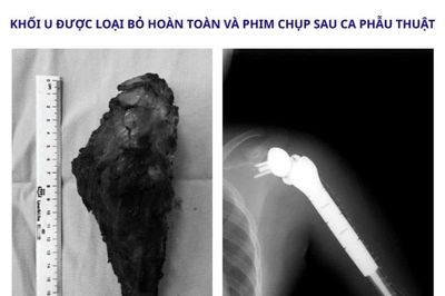 Thay khớp vai đảo ngược, giữ lại cánh tay cho bệnh nhi 14 tuổi ung thư xương