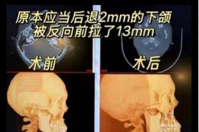 Cô gái Trung Quốc bị biến dạng khuôn mặt sau phẫu thuật chỉnh hàm