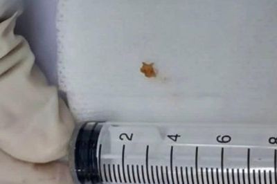 Tưởng viêm phế quản, bé 3 tuổi mắc dị vật đường thở suốt hơn 1 tháng