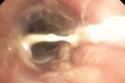 Bé trai ho suốt một tháng, đi khám gia đình bất ngờ khi biết lý do