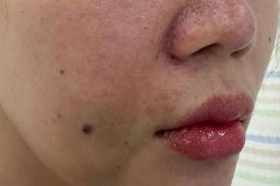 Cô gái bị tắc mạch, hoại tử sau khi tiêm filler làm đầy rãnh cười ở spa