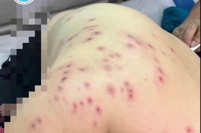 121 mũi ong đốt, người bệnh suy đa cơ quan, phải lọc máu