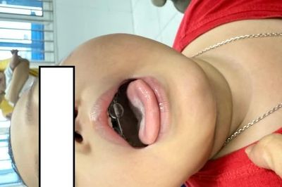 Tím tái khi ngủ, bé 4 tuổi được phát hiện hội chứng hiếm gặp do béo phì