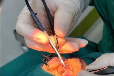 Nhiều ca mộng thịt nặng được xử lý, cẩn trọng nguy cơ bệnh nền