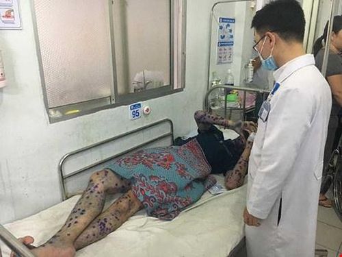 Một công nhân mắc thủy đậu đang điều trị tại bệnh viện. Ảnh: Trần Ngọc