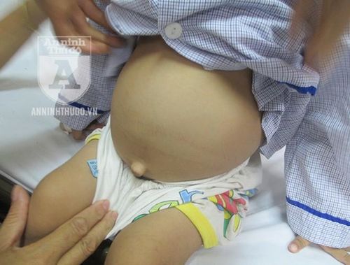 Bệnh nhi mắc chứng tan máu bẩm sinh thường có bụng chướng to vì lá lách "sưng". Các em thường phải cắt lá lách, và nhận máu điều trị hằng tháng