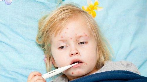 Bệnh sởi là một loại ôn bệnh, dễ phát triển thành ôn dịch.