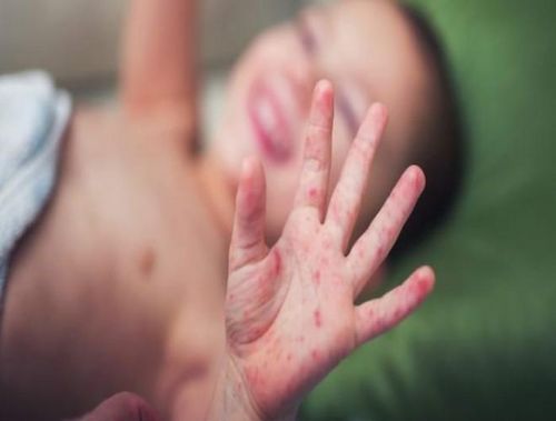  Bệnh Tay - Chân - Miệng: Là căn bệnh truyền nhiễm cấp tính do virus thuộc nhóm Enterovirus gây ra. Bệnh lây từ người sang người do tiếp xúc trực tiếp với nước bọt, dịch tiết mũi, họng, dịch của các bọng nước khi vỡ hoặc qua đường phân - miệng 