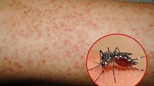 Cần phân biệt đúng sốt xuất huyết với các bệnh khác để có phương pháp điều trị bệnh chính xác và hiệu quả. (Ảnh: Vinmec)