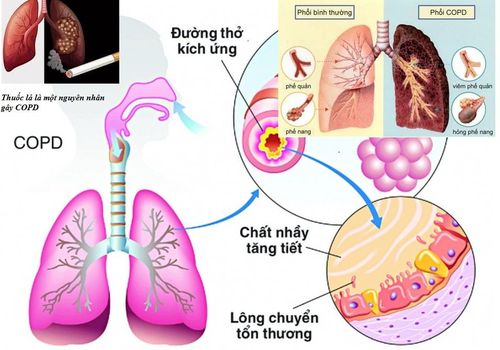 Tổn thương phổi trong bệnh phổi tắc nghẽn mạn tính.