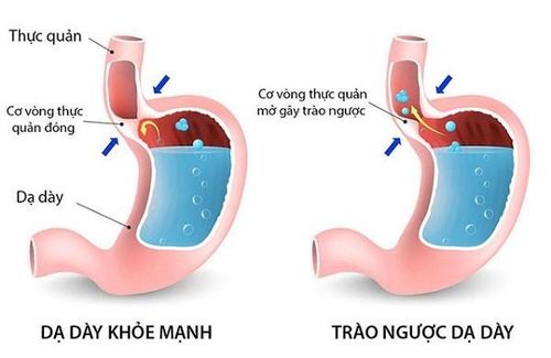 Trào ngược dạ dày - thực quản là một nguyên nhân gây ho khan.