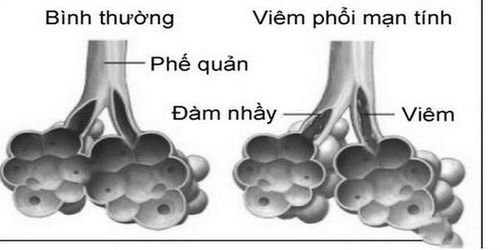 Không được chủ quan với viêm phổi ở người lớn.