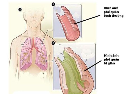 Giãn phế quản, viêm phế quản cũng có thể gây ho ra máu.