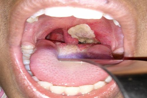 Triệu chứng dễ nhận thấy nhất của bệnh bạch hầu là hình thành mảng màu xám, dày ở họng và amidan. Ảnh: Internet.