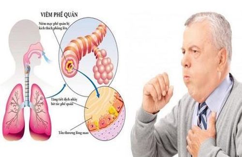 COPD là lý do thứ 3 dẫn đến tử vong trên toàn cầu. (Ảnh minh họa).