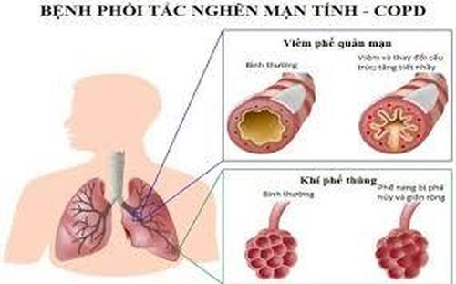 Người có bệnh nền COPD dễ mắc và tử vong khi nhiễm COVID-19.