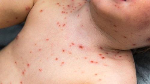 Dấu hiệu nhận biết khi bệnh khởi phát là nổi mụn nước ở mặt sau đó lan ra toàn thân - Ảnh Internet