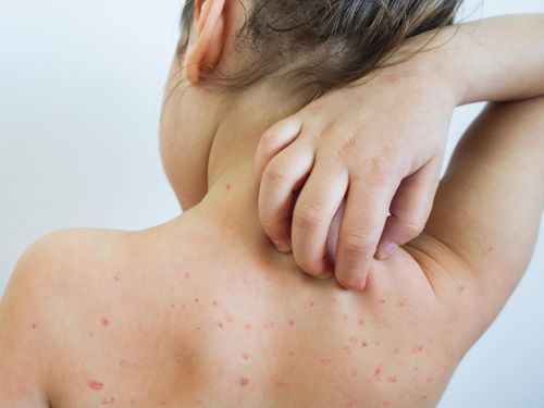 Phát ban là dấu hiệu bệnh sởi xuất hiện vào giai đoạn toàn phát của bệnh sởi - Ảnh: Internet