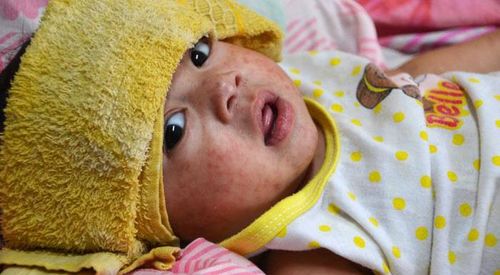 Bệnh sởi có tự khỏi không phụ thuộc rất lớn vào chế độ chăm sóc người bệnh - Ảnh: Internet