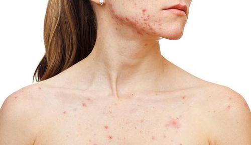 Người lớn bị sởi xuất hiện tình trạng nhiễm khuẩn, lúc này bệnh nhân cần được dùng kháng sinh để tránh tình trạng biến chứng - Ảnh Internet