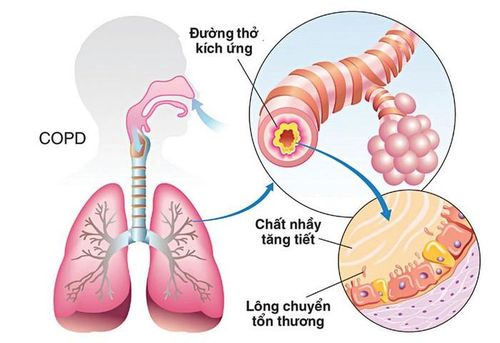 Phương pháp thông khí, giảm khó thở khi bị COPD - Ảnh: Internet