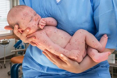 Khi có các dấu hiệu bị sởi, bố mẹ nên để trẻ nghỉ học và tiến hành cách ly tại nhà - Ảnh: Internet