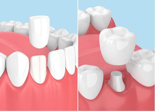  Dán veneer sứ (trái) và bọc mão sứ (phải). Ảnh: Vital Europe. 